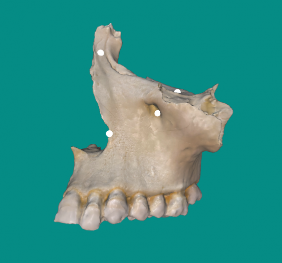 上颌骨Maxillary Bone