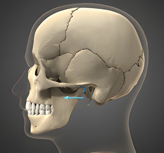 下颌前突mandibular protrusion