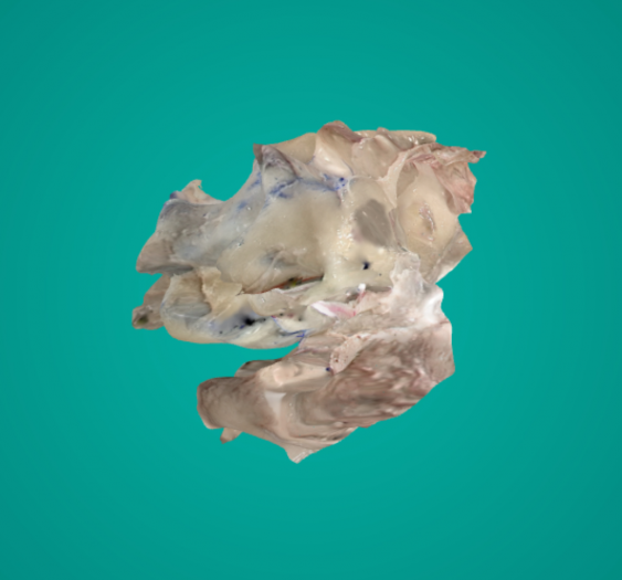 蝶窦Sphenoid Sinus