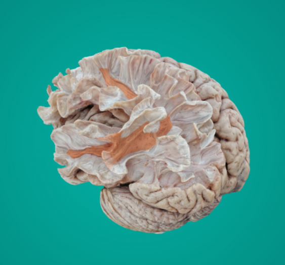 弓状束Arcuate Fasciculus