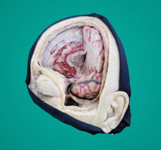 颅骨切开术步骤Craniotomy - step