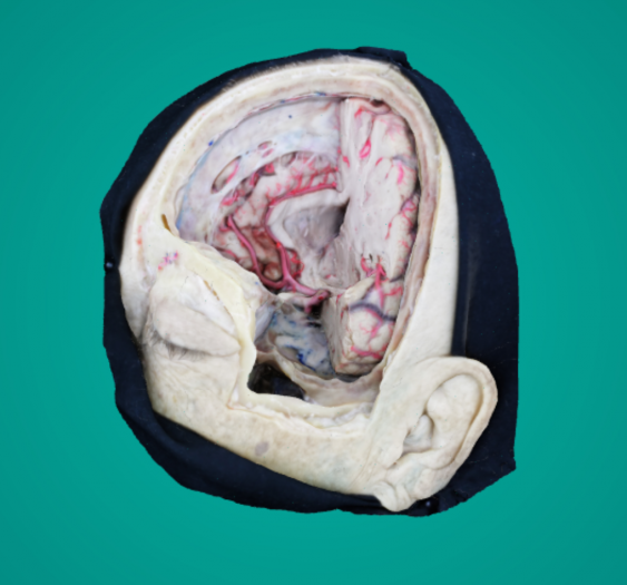 颅骨切开术步骤Craniotomy - Step 3