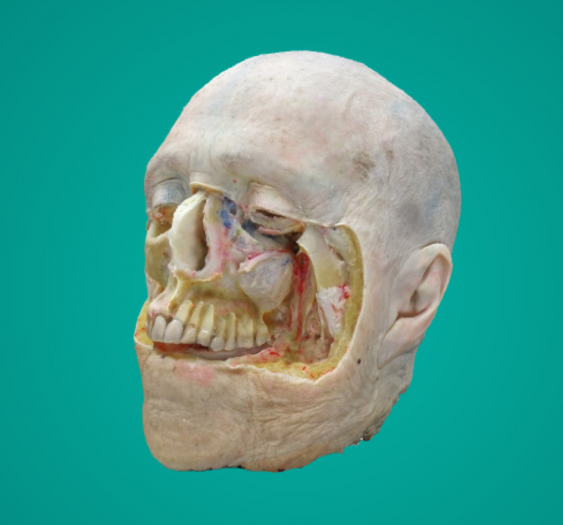 上颌窦Maxillary sinus