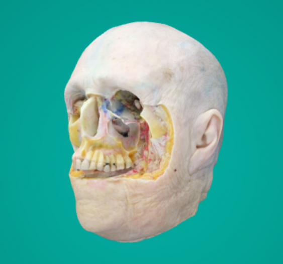 上颌窦开口Maxillary sinus open