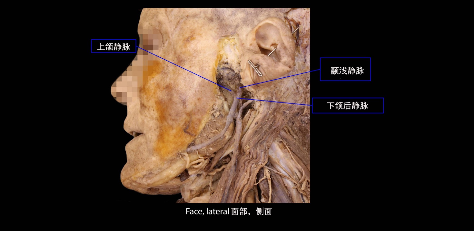 颞浅 + 上颌静脉 = 下颌后静脉