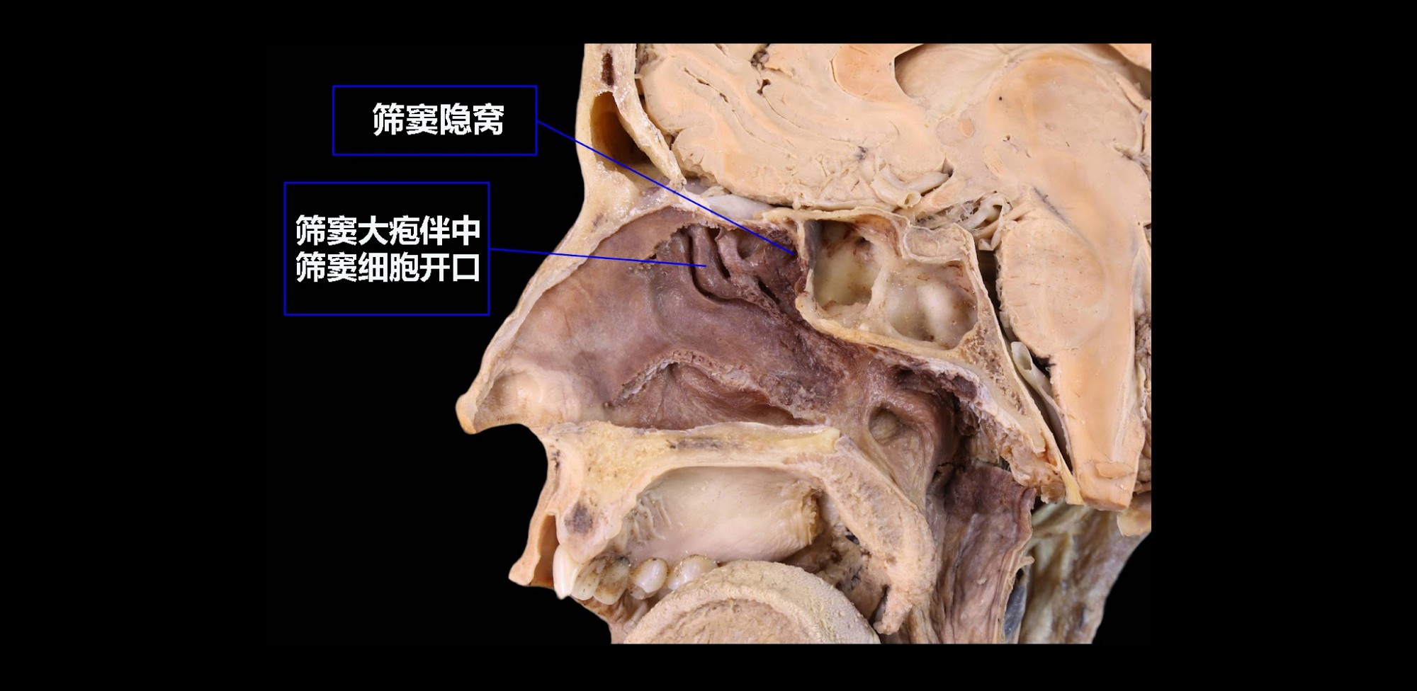 蝶筛隐窝和筛大泡