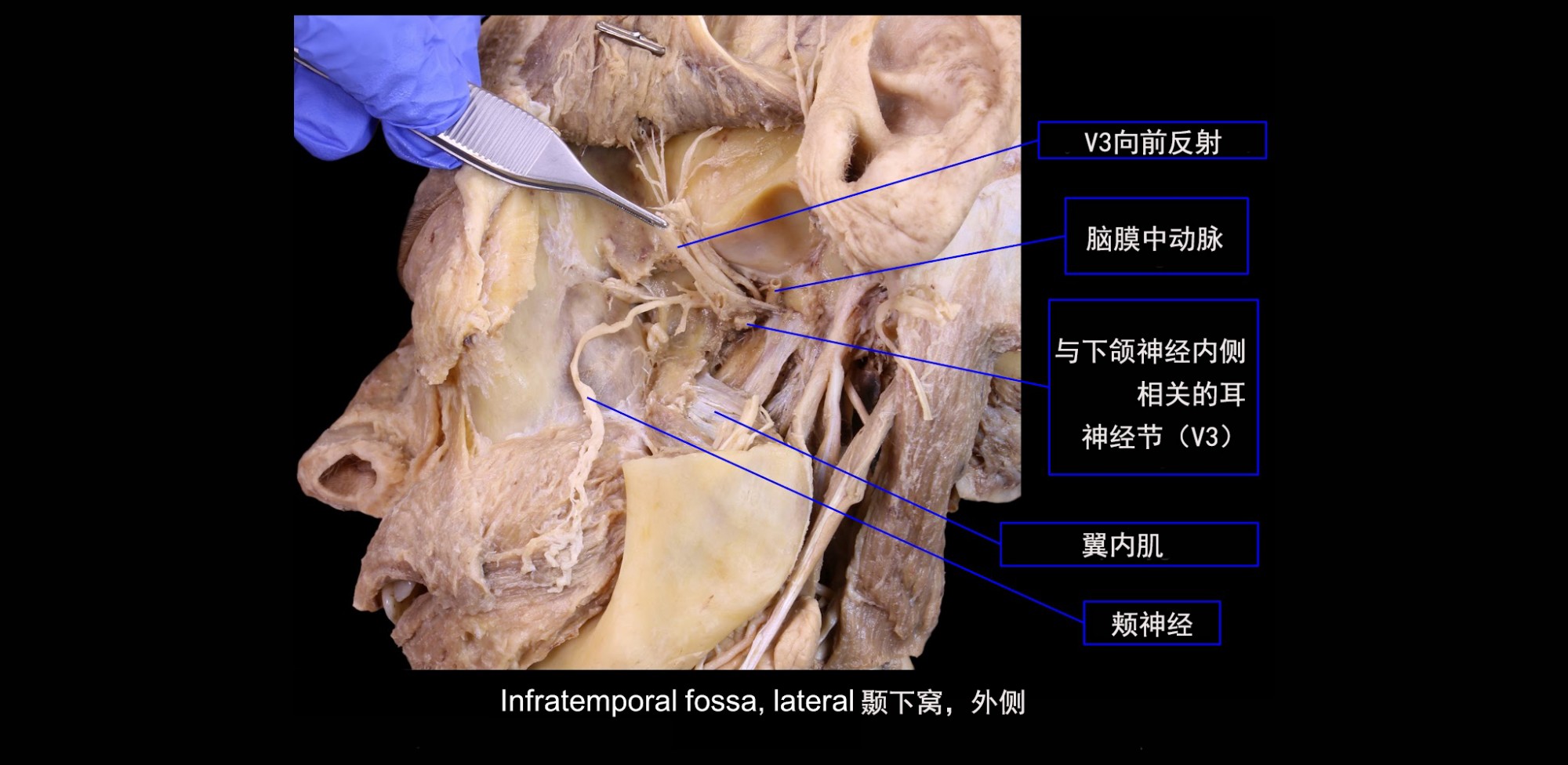 下颌神经 (V3),后部,耳神经节